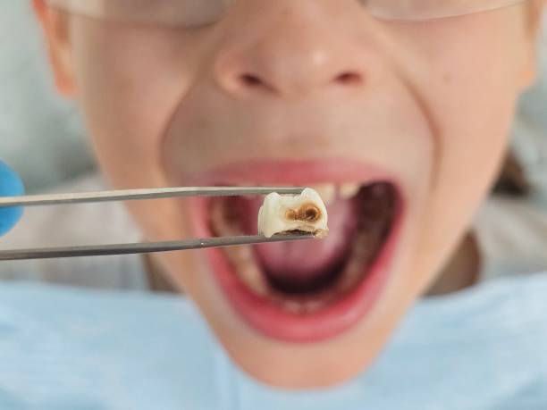 Best Emergency Dentist for Lost Fillings or Crowns in Rogersville, TN